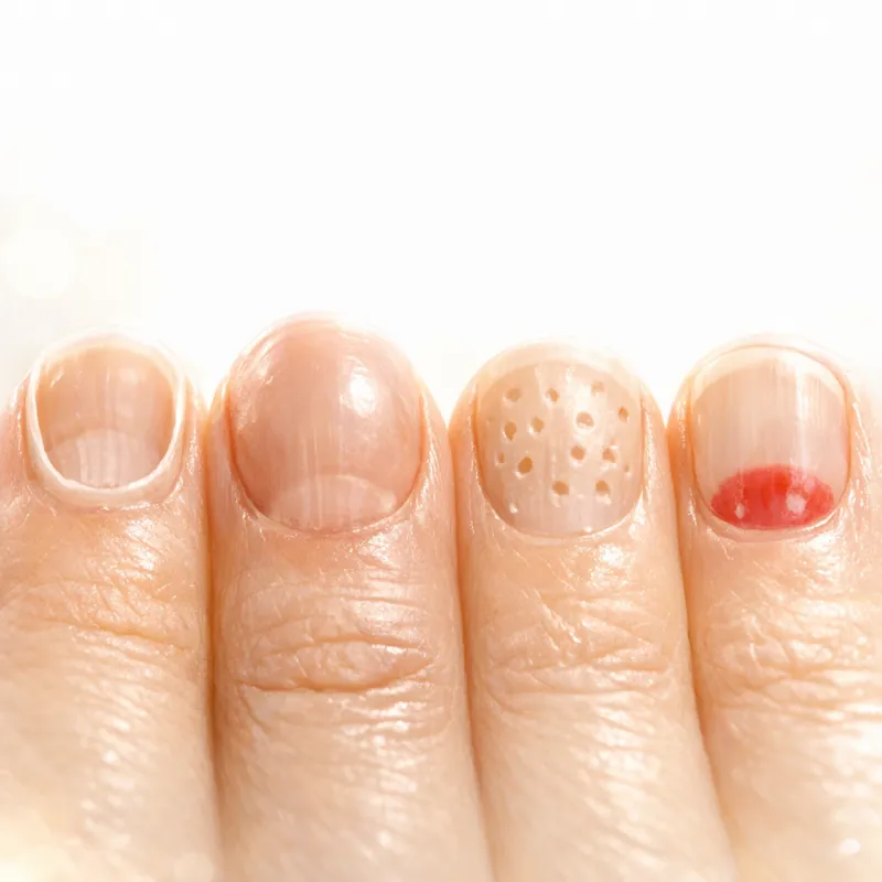 Что ваши ногти могут рассказать о здоровье