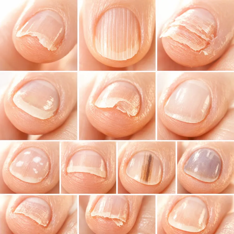 Что ваши ногти могут рассказать о здоровье