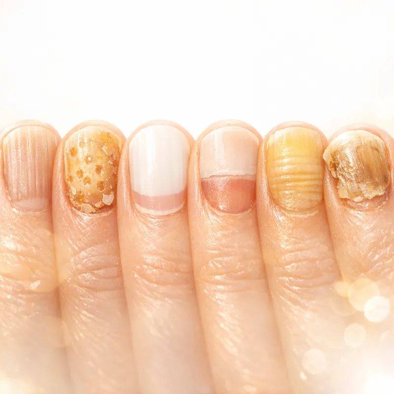 Что ваши ногти могут рассказать о здоровье