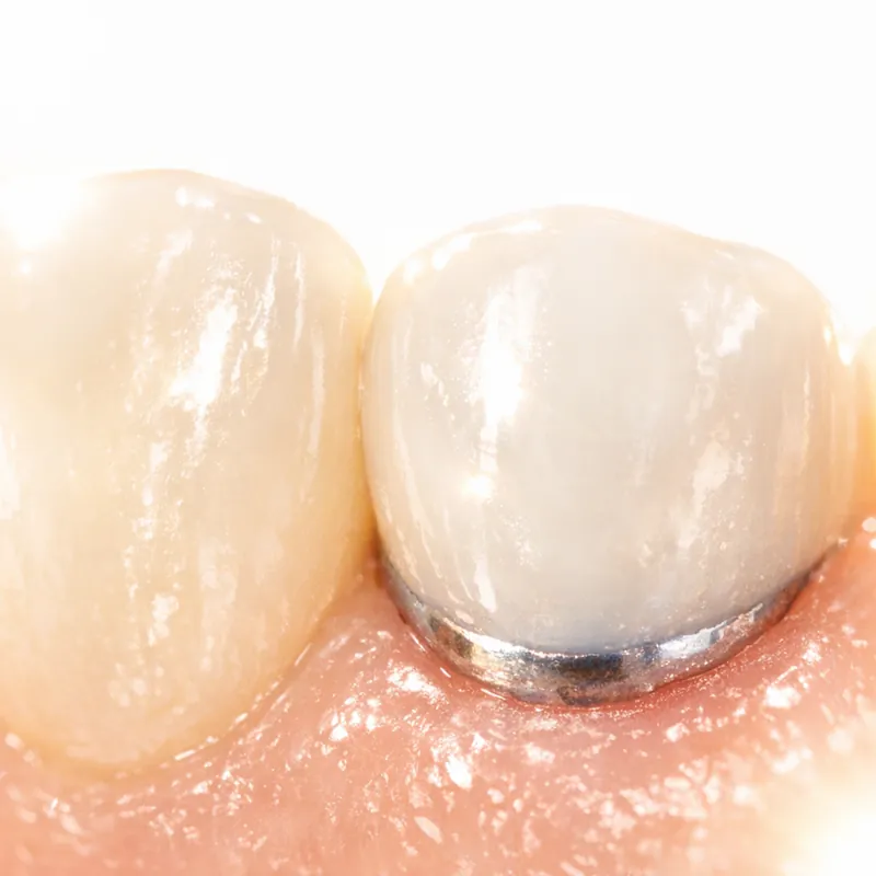 Чёрный ободок вокруг коронки как эстетическая катастрофа