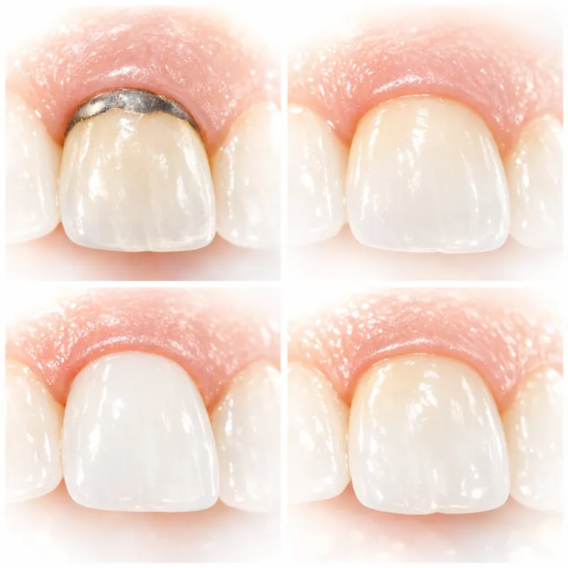 Чёрный ободок вокруг коронки как эстетическая катастрофа