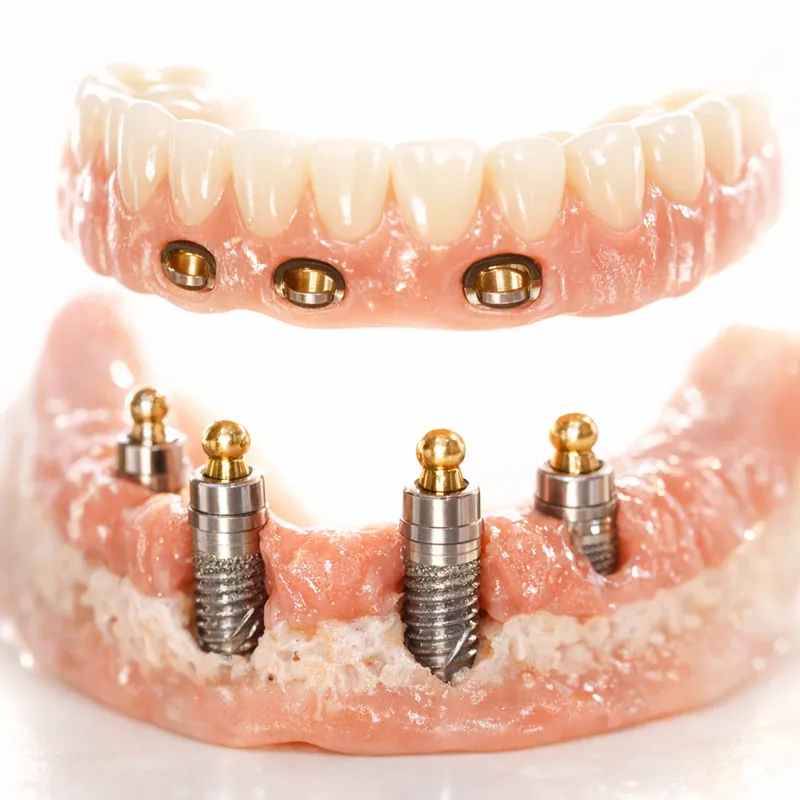 Съемные протезы на имплантах как полная реабилитация улыбки и жевательной функции