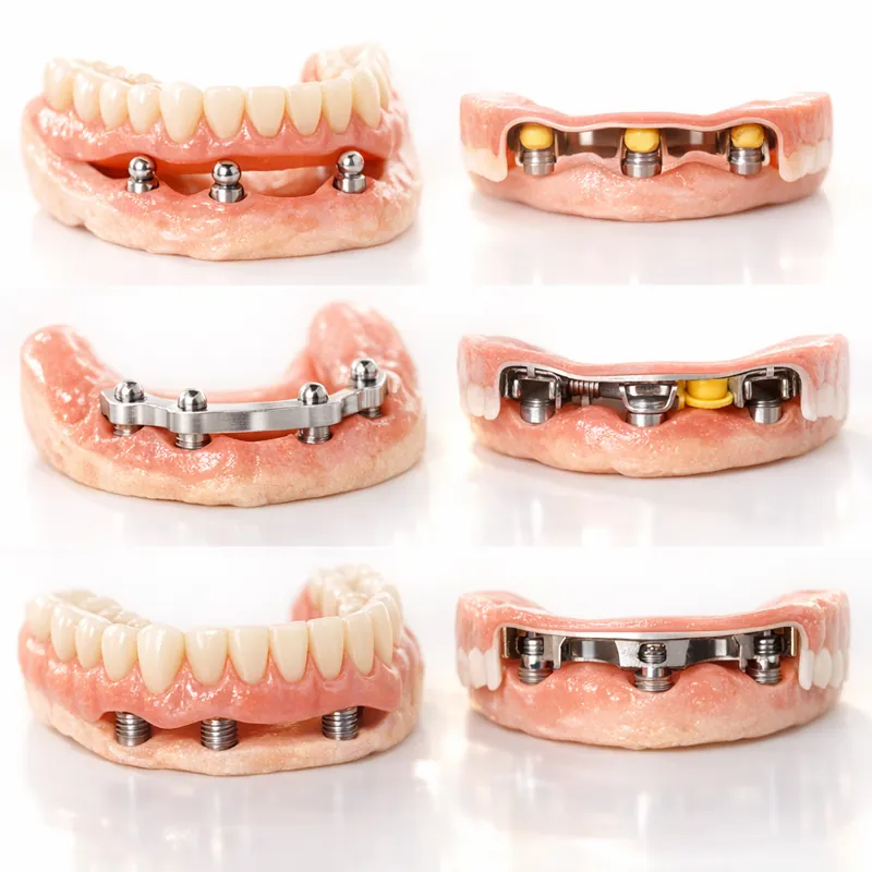 Съемные протезы на имплантах как полная реабилитация улыбки и жевательной функции