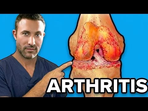 Treating Arthritis Without Surgery